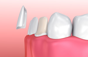 Illustration of a veneer that came off the tooth